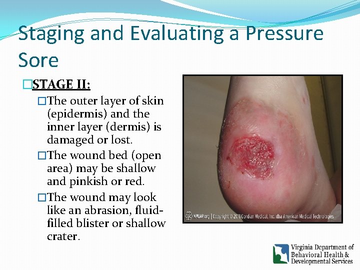 Staging and Evaluating a Pressure Sore �STAGE II: �The outer layer of skin (epidermis) Staging and Evaluating a Pressure Sore �STAGE II: �The outer layer of skin (epidermis)