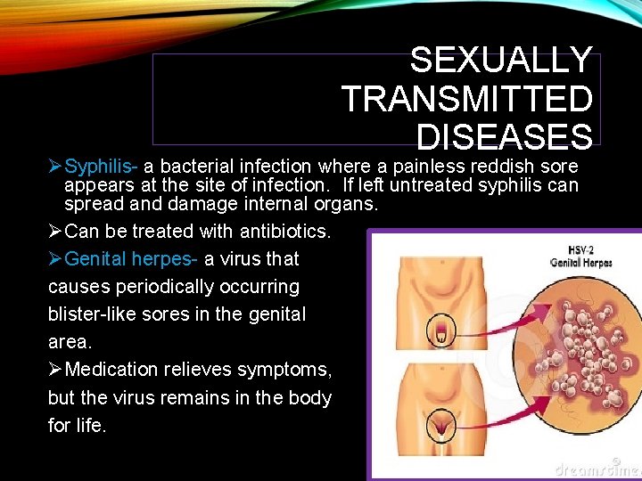 SEXUALLY TRANSMITTED DISEASES ØSyphilis- a bacterial infection where a painless reddish sore appears at