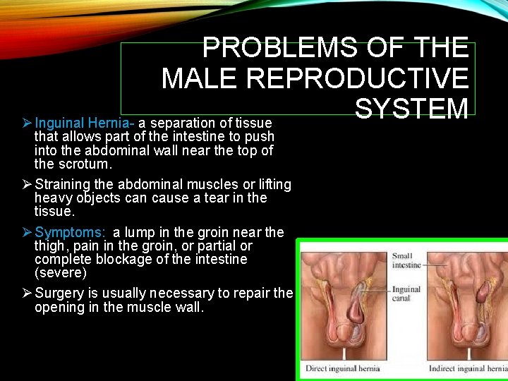 PROBLEMS OF THE MALE REPRODUCTIVE SYSTEM Ø Inguinal Hernia- a separation of tissue that