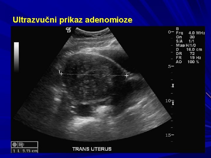 Ultrazvučni prikaz adenomioze 