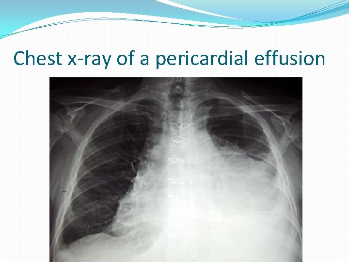 Chest x-ray of a pericardial effusion 