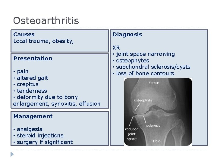 Osteoarthritis Causes Local trauma, obesity, Presentation • pain • altered gait • crepitus •