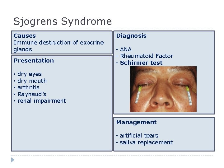 Sjogrens Syndrome Causes Immune destruction of exocrine glands Presentation • • • Diagnosis •