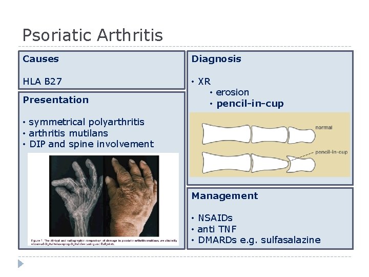 Psoriatic Arthritis Causes Diagnosis HLA B 27 • XR • erosion • pencil-in-cup Presentation