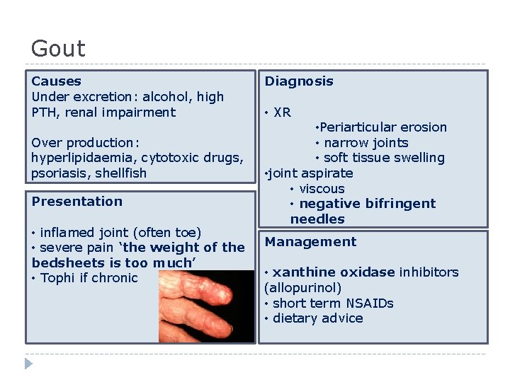 Gout Causes Under excretion: alcohol, high PTH, renal impairment Over production: hyperlipidaemia, cytotoxic drugs,