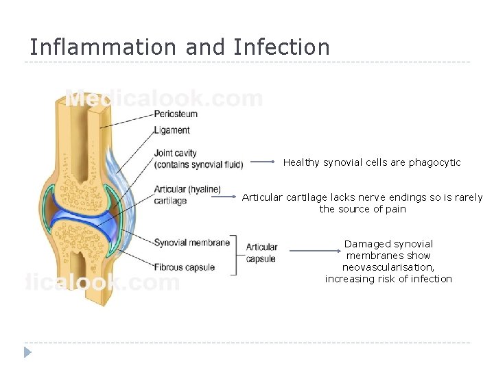 Inflammation and Infection Healthy synovial cells are phagocytic Articular cartilage lacks nerve endings so