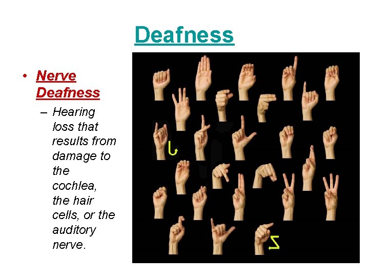 Deafness • Nerve Deafness – Hearing loss that results from damage to the cochlea,