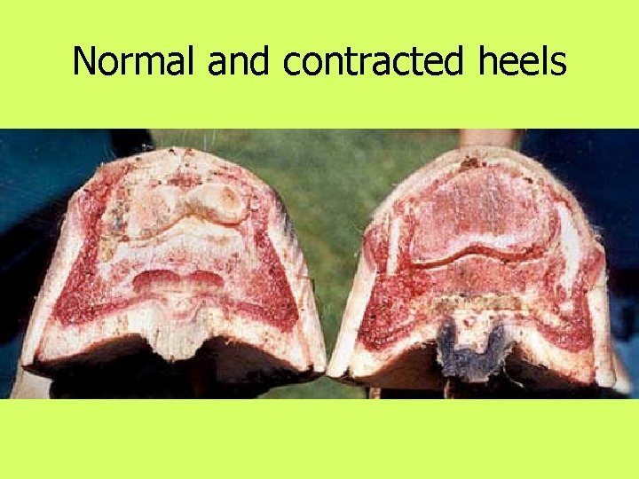 Normal and contracted heels 