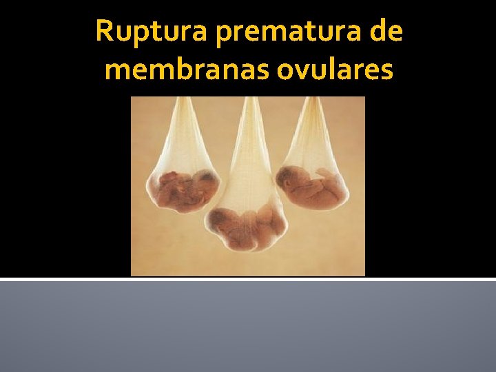 Ruptura prematura de membranas ovulares 