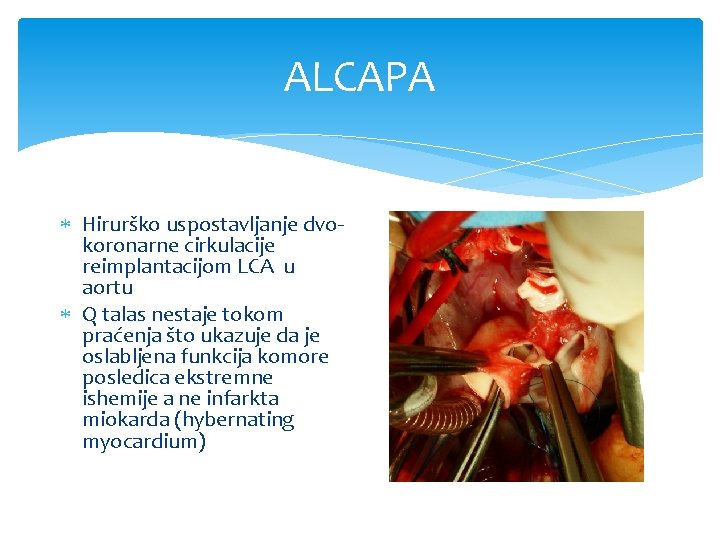 ALCAPA Hirurško uspostavljanje dvokoronarne cirkulacije reimplantacijom LCA u aortu Q talas nestaje tokom praćenja