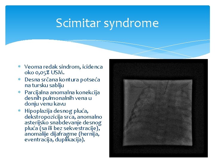 Scimitar syndrome Veoma redak sindrom, icidenca oko 0, 05% USM. Desna srčana kontura potseća