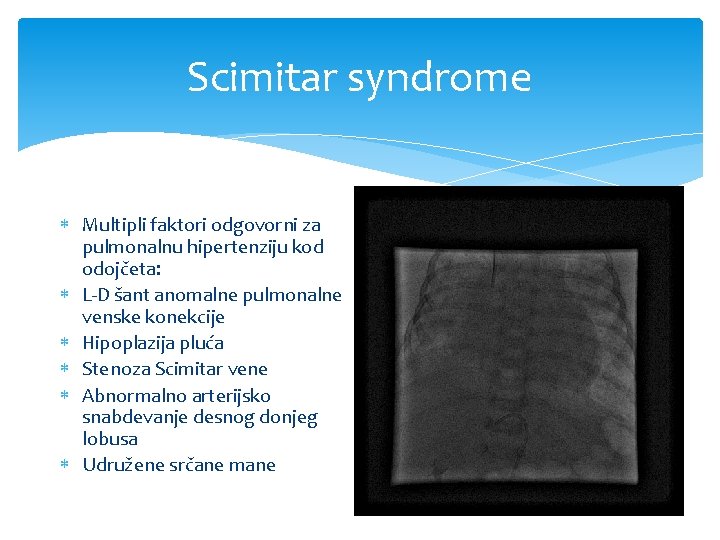 Scimitar syndrome Multipli faktori odgovorni za pulmonalnu hipertenziju kod odojčeta: L-D šant anomalne pulmonalne