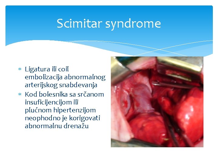 Scimitar syndrome Ligatura ili coil embolizacija abnormalnog arterijskog snabdevanja Kod bolesnika sa srčanom insuficijencijom