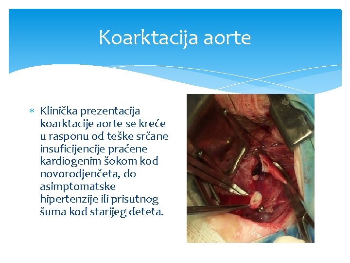 Koarktacija aorte Klinička prezentacija koarktacije aorte se kreće u rasponu od teške srčane insuficijencije