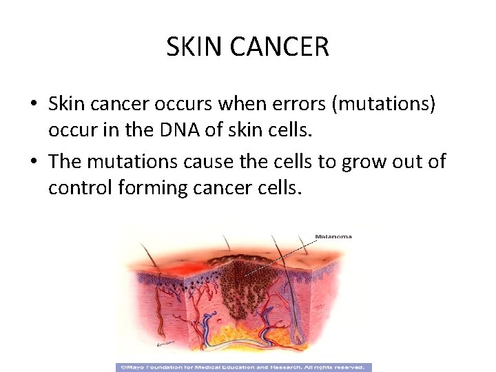 SKIN CANCER • Skin cancer occurs when errors (mutations) occur in the DNA of