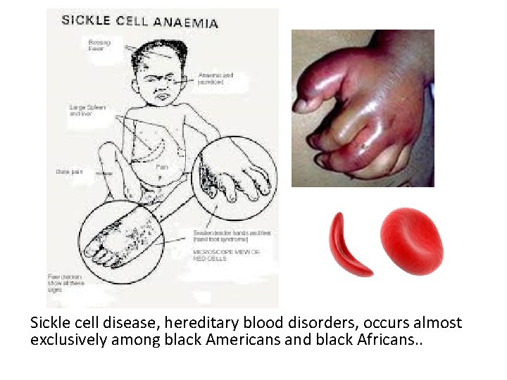 Sickle cell disease, hereditary blood disorders, occurs almost exclusively among black Americans and black