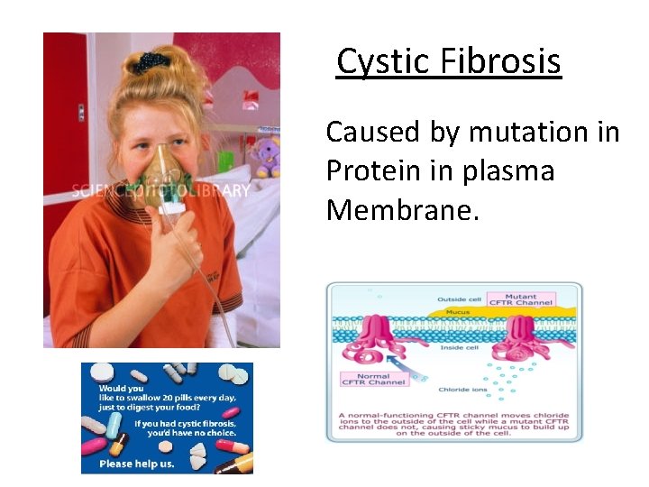 Cystic Fibrosis Caused by mutation in Protein in plasma Membrane. 