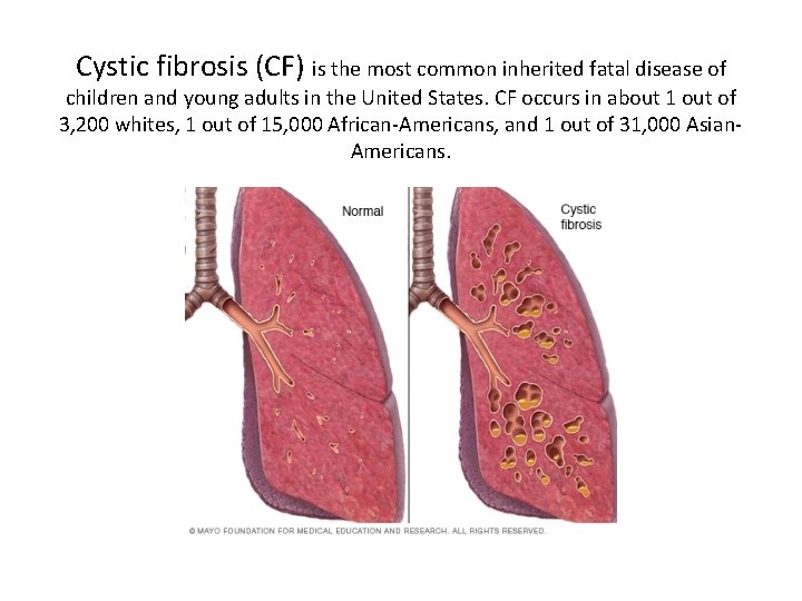 Cystic fibrosis (CF) is the most common inherited fatal disease of children and young