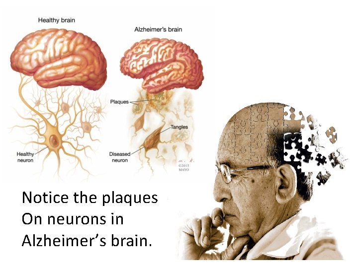 Notice the plaques On neurons in Alzheimer’s brain. 