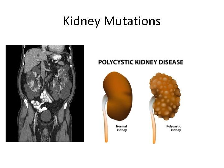 Kidney Mutations 