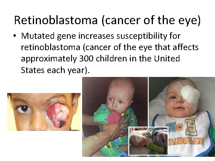 Retinoblastoma (cancer of the eye) • Mutated gene increases susceptibility for retinoblastoma (cancer of
