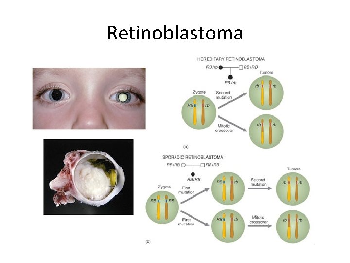 Retinoblastoma 