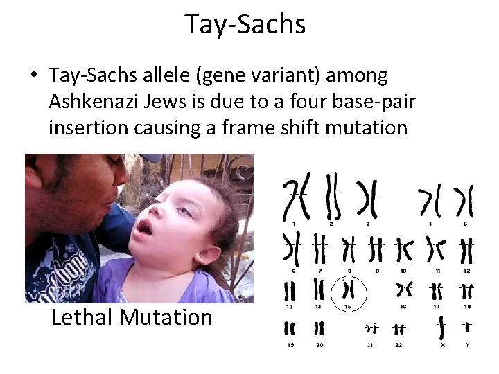 Tay-Sachs • Tay-Sachs allele (gene variant) among Ashkenazi Jews is due to a four