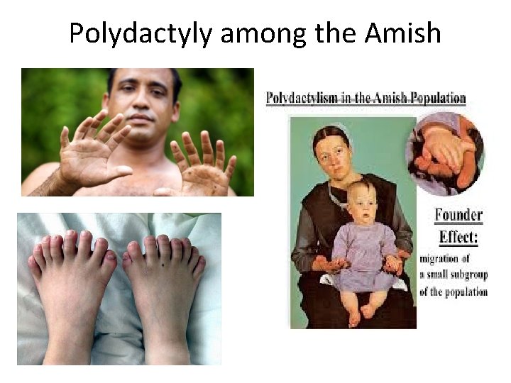 Polydactyly among the Amish 