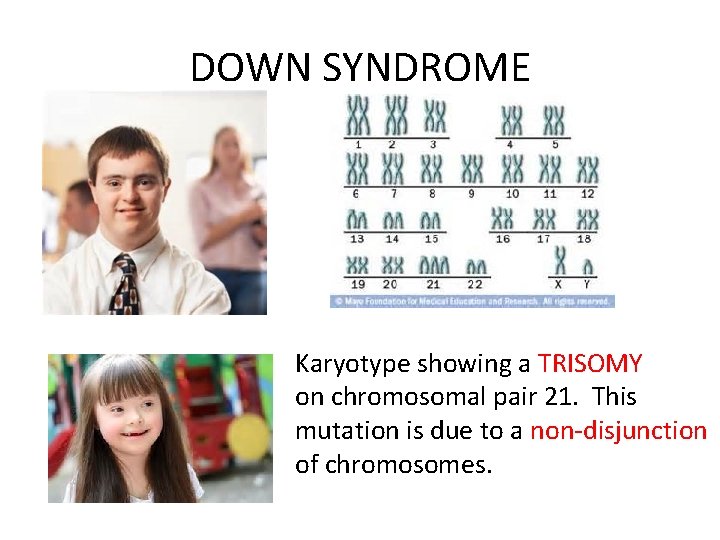 DOWN SYNDROME Karyotype showing a TRISOMY on chromosomal pair 21. This mutation is due