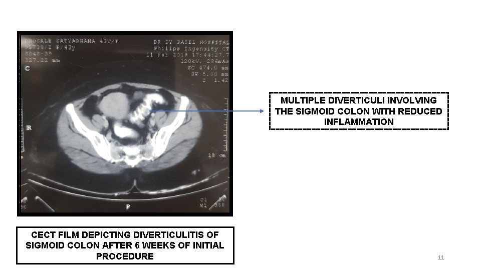 MULTIPLE DIVERTICULI INVOLVING THE SIGMOID COLON WITH REDUCED INFLAMMATION CECT FILM DEPICTING DIVERTICULITIS OF