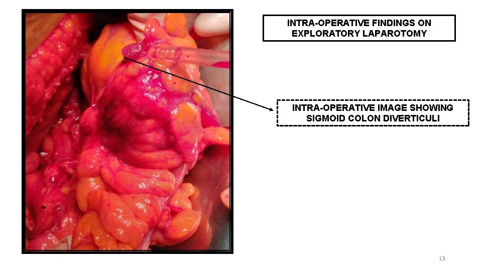 INTRA-OPERATIVE FINDINGS ON EXPLORATORY LAPAROTOMY INTRA-OPERATIVE IMAGE SHOWING SIGMOID COLON DIVERTICULI 13 