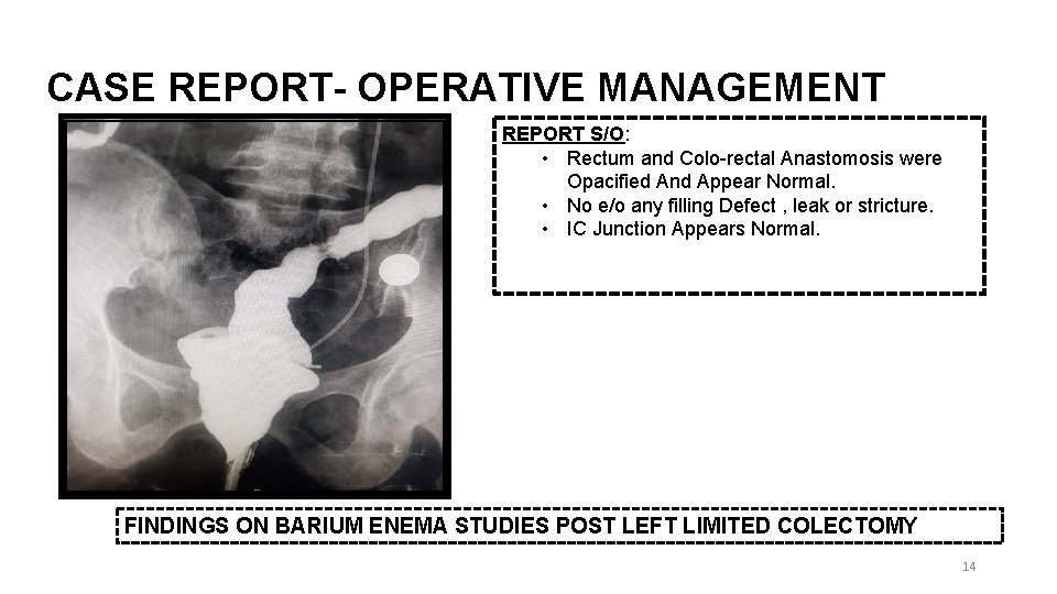 CASE REPORT- OPERATIVE MANAGEMENT REPORT S/O: • Rectum and Colo-rectal Anastomosis were Opacified And