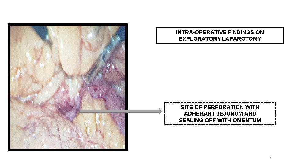 INTRA-OPERATIVE FINDINGS ON EXPLORATORY LAPAROTOMY SITE OF PERFORATION WITH ADHERANT JEJUNUM AND SEALING OFF