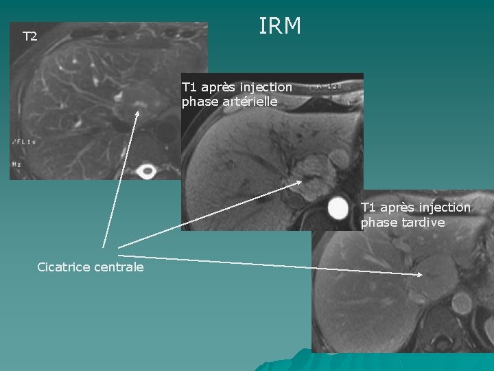 T 2 IRM T 1 après injection phase artérielle T 1 après injection phase