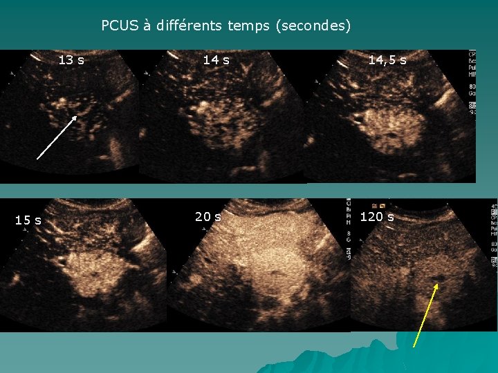 PCUS à différents temps (secondes) 13 s 15 s 14 s 20 s 14,