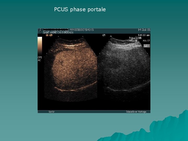 PCUS phase portale 