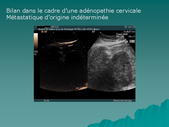 Bilan dans le cadre d’une adénopathie cervicale Métastatique d’origine indéterminée 