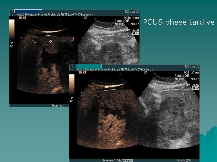PCUS phase tardive 