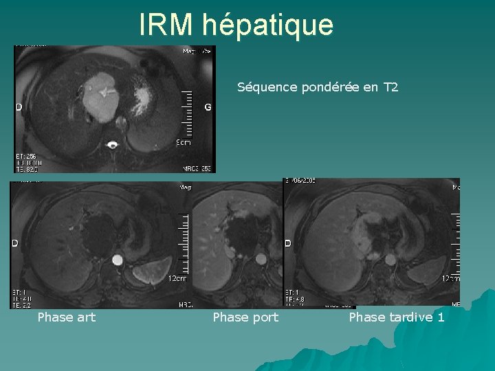 IRM hépatique Séquence pondérée en T 2 Phase art Phase port Phase tardive 1