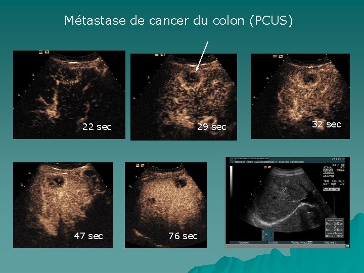 Métastase de cancer du colon (PCUS) 22 sec 29 sec 32 sec Avant injection