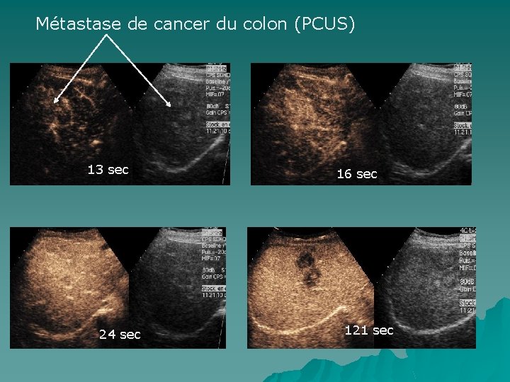 Métastase de cancer du colon (PCUS) 13 sec 24 sec 16 sec 121 sec