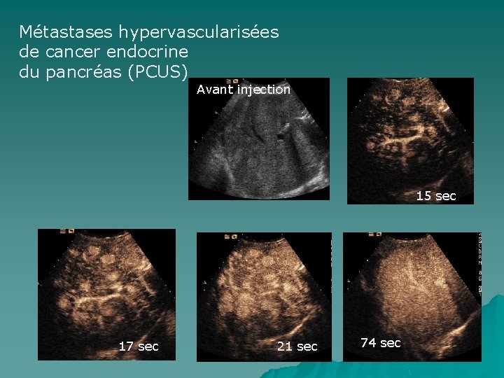 Métastases hypervascularisées de cancer endocrine du pancréas (PCUS) Avant injection 15 sec 17 sec