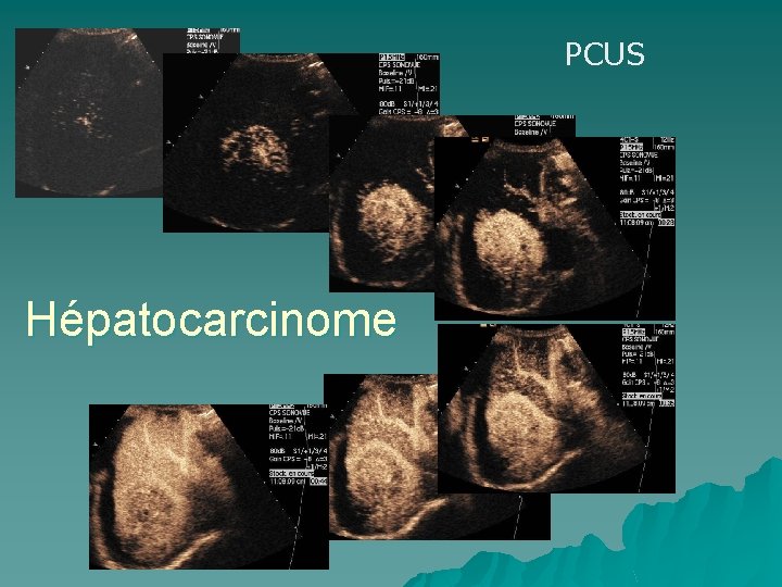 PCUS Hépatocarcinome 