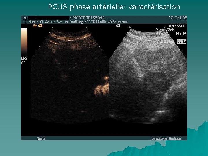 PCUS phase artérielle: caractérisation 