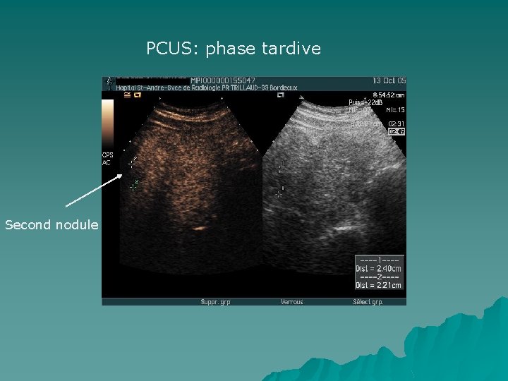 PCUS: phase tardive Second nodule 