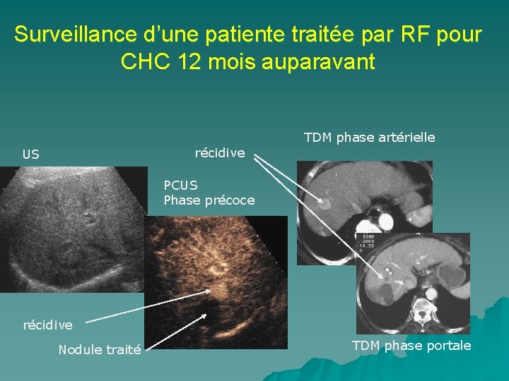 Surveillance d’une patiente traitée par RF pour CHC 12 mois auparavant TDM phase artérielle