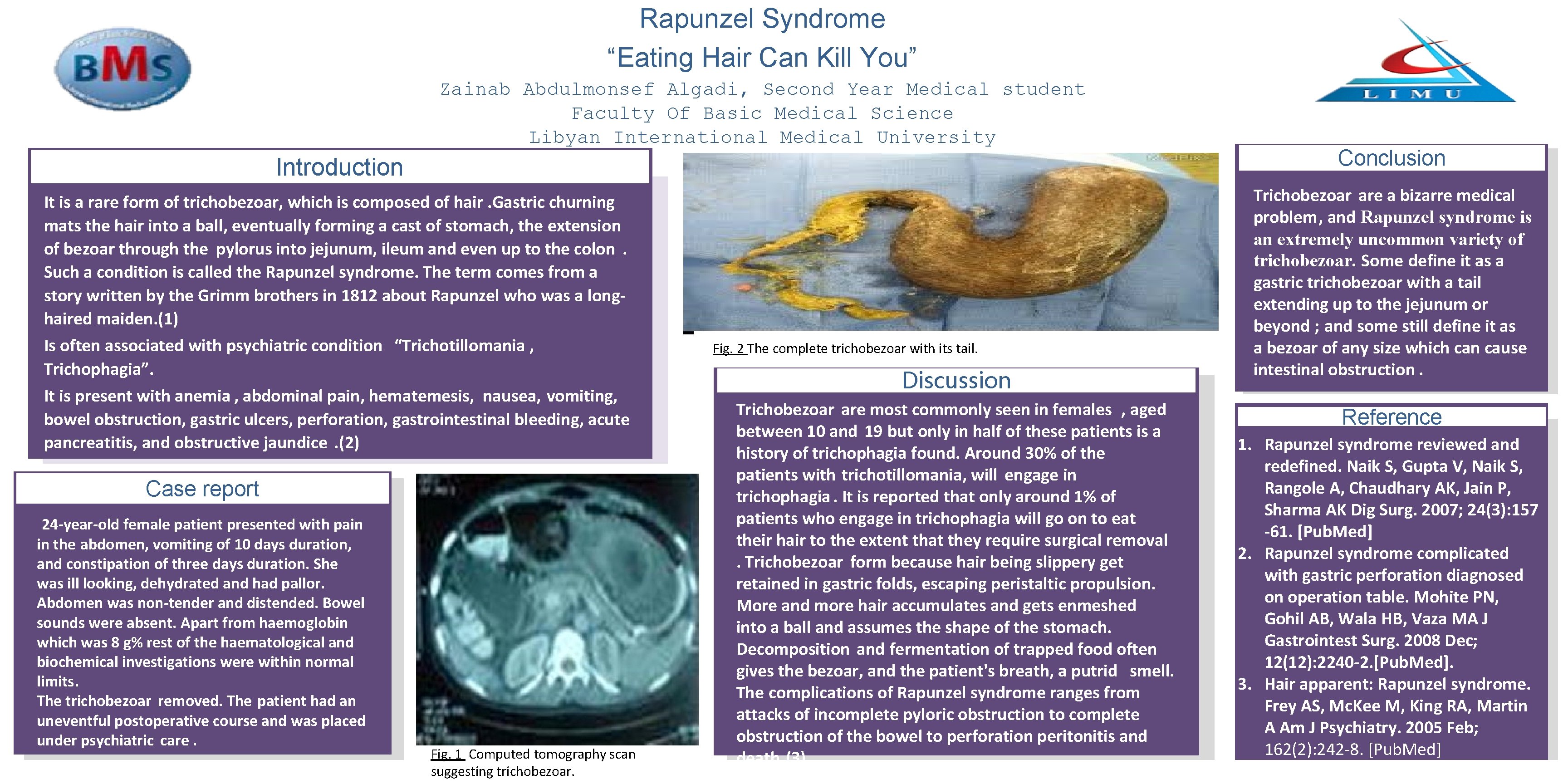 Rapunzel Syndrome “Eating Hair Can Kill You” Zainab Abdulmonsef Algadi, Second Year Medical student