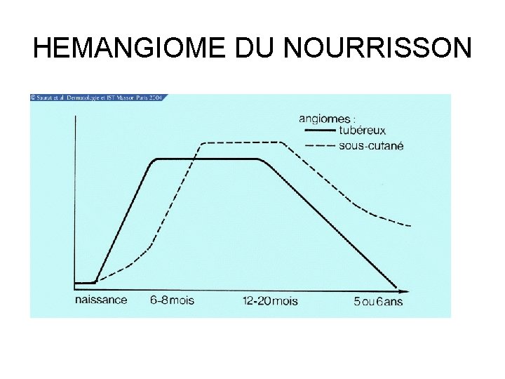 HEMANGIOME DU NOURRISSON 