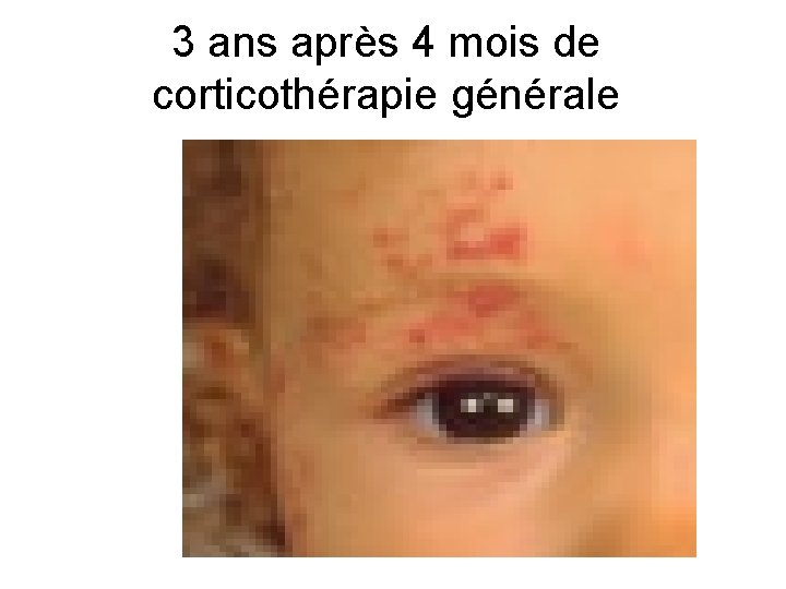 3 ans après 4 mois de corticothérapie générale 