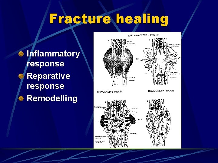 Fracture healing Inflammatory response Reparative response Remodelling 